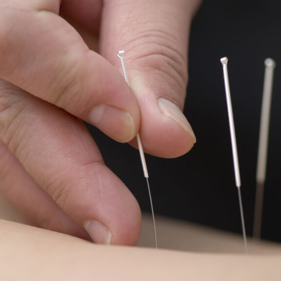 acupuncture